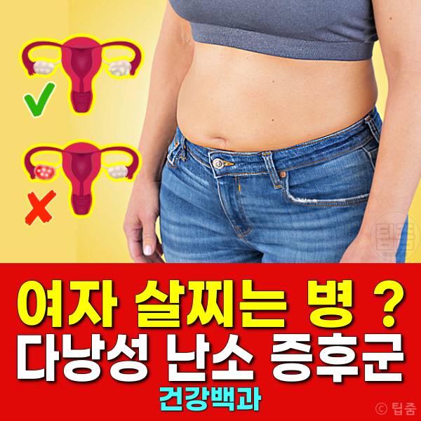 다낭성난소증후군 증상 자가진단 여자 살찌는병