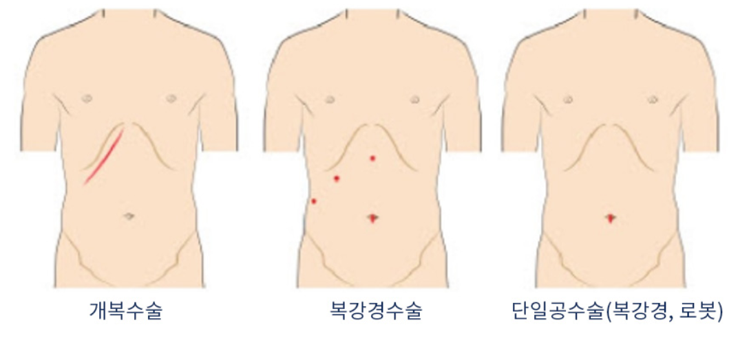 담낭절제술-출처-한국간담췌외과학회