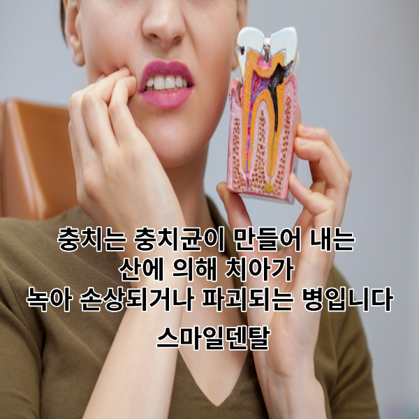 치아-충치-충치균-썸네일