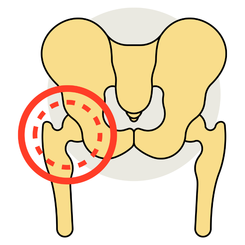 골반 고관절 뚝뚝 소리 나는 이유는?