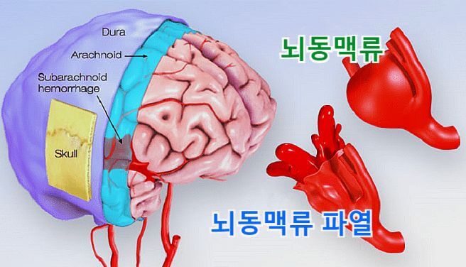 뇌동맥류 증상