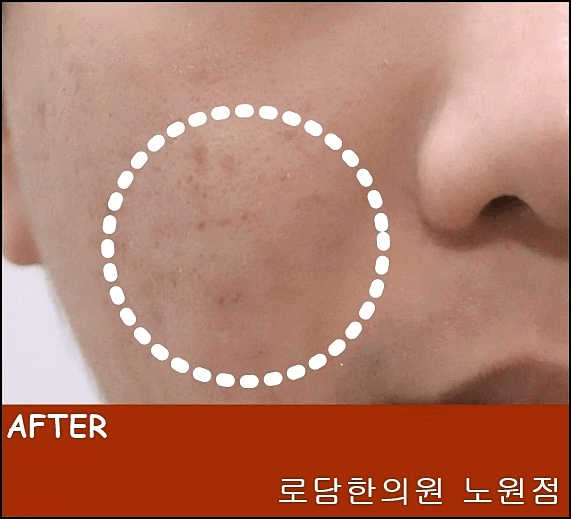  노원여드름흉터 제거 새살침 코라테라피 치료과정