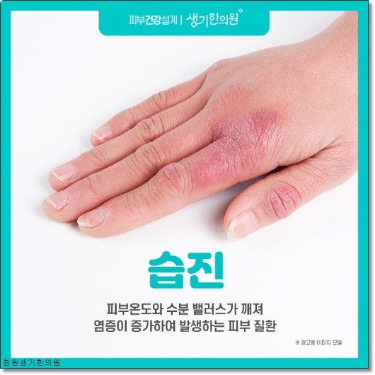 마산습진 치료의 비결은 안정적인 생활습관을 유지하는 것입니다. 2