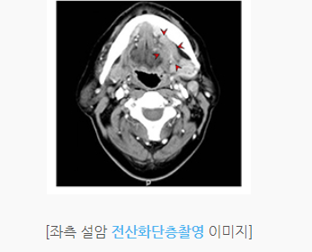 목에 뭐가 걸린느낌 설암 검사 치료방법 - 도움이 되는 블로그