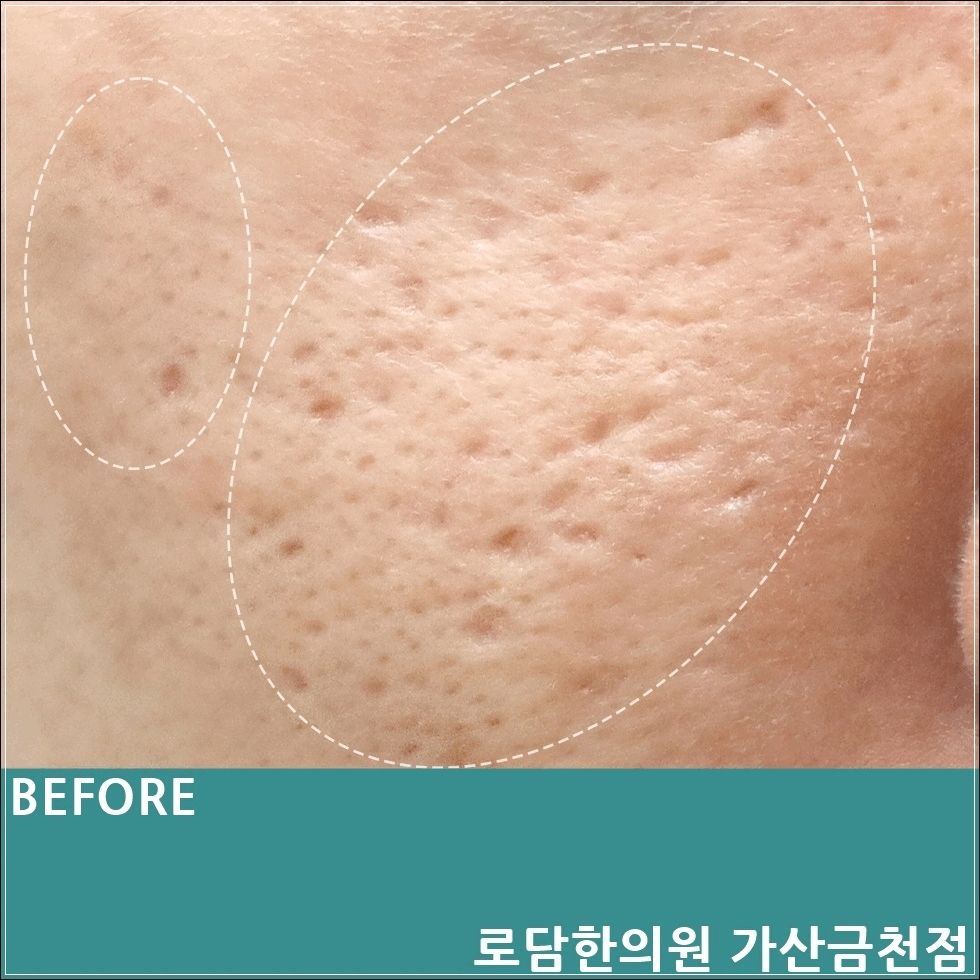  부천여드름흉터 시술 새살침 코라테라피 치료 과정