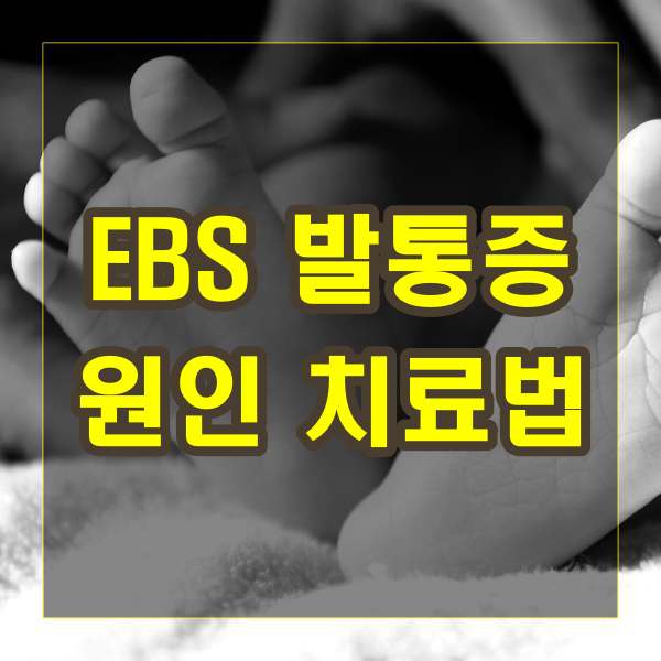 EBS 발통증 원인 및 치료법