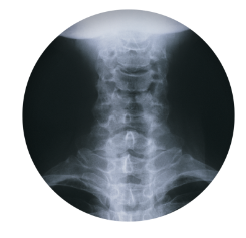 경추 디스크 증상