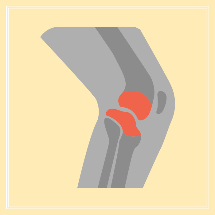 무릎 연골연화증 운동 재활로 무릎 건강 관리하기