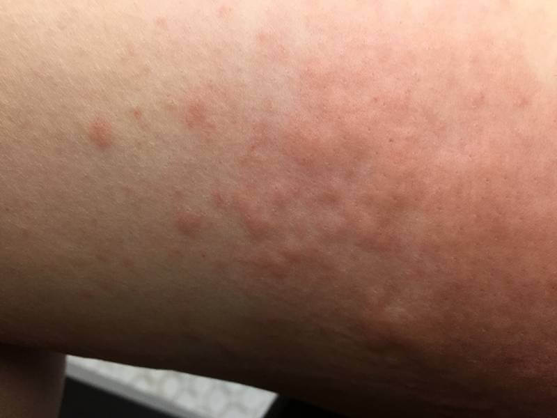  콜린성 두드러기 원인 및 치료 체크