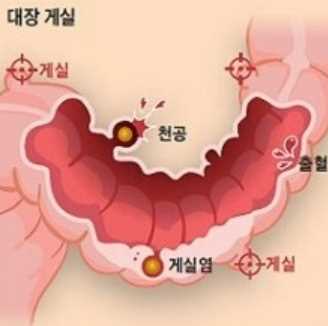 오른쪽 갈비뼈 아래 통증 - 게실염