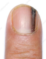 Melanonychia 1