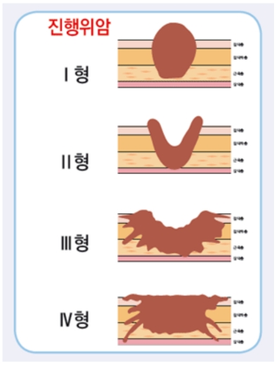 의학용어 AGC 진행성 위암 검사방법