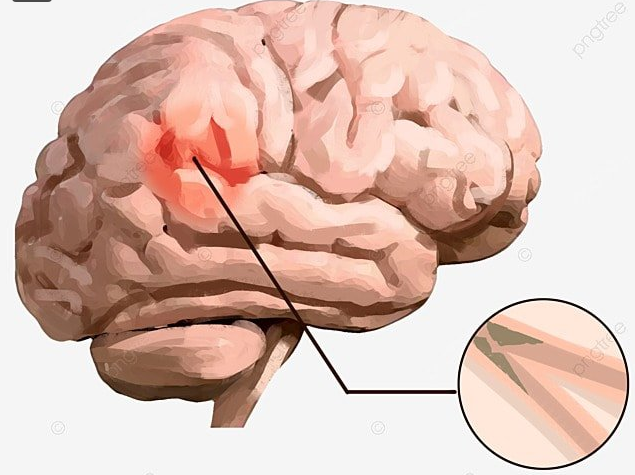 뇌졸증 환자의 뇌