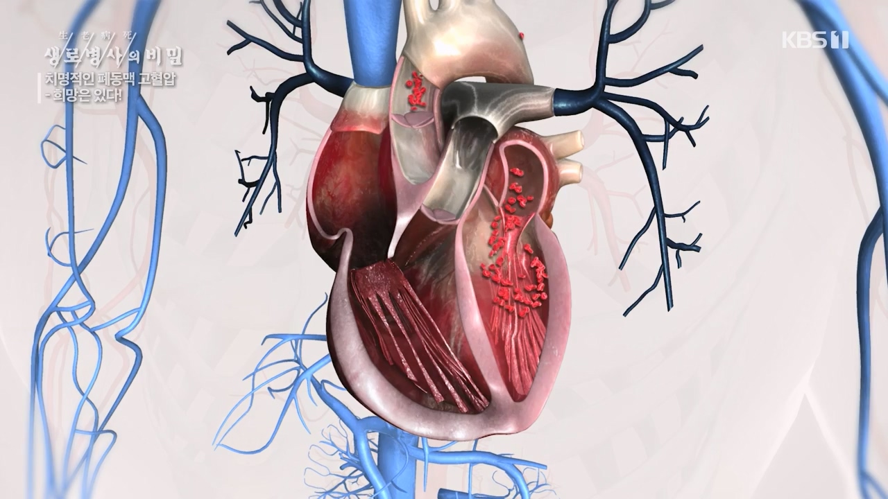 생로병사의 비밀.E900.240215p-NEXT.mp4_20240215_202904.235.jpg
