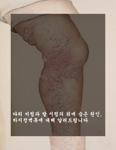  다리 저림과 발 시림의 뒤에 숨은 원인, 하지정맥류에 대해 알려드립니다