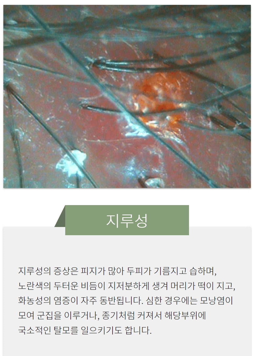 머리속 피부염 두피 지루성 피부염 치료