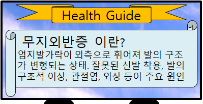 무지외반증