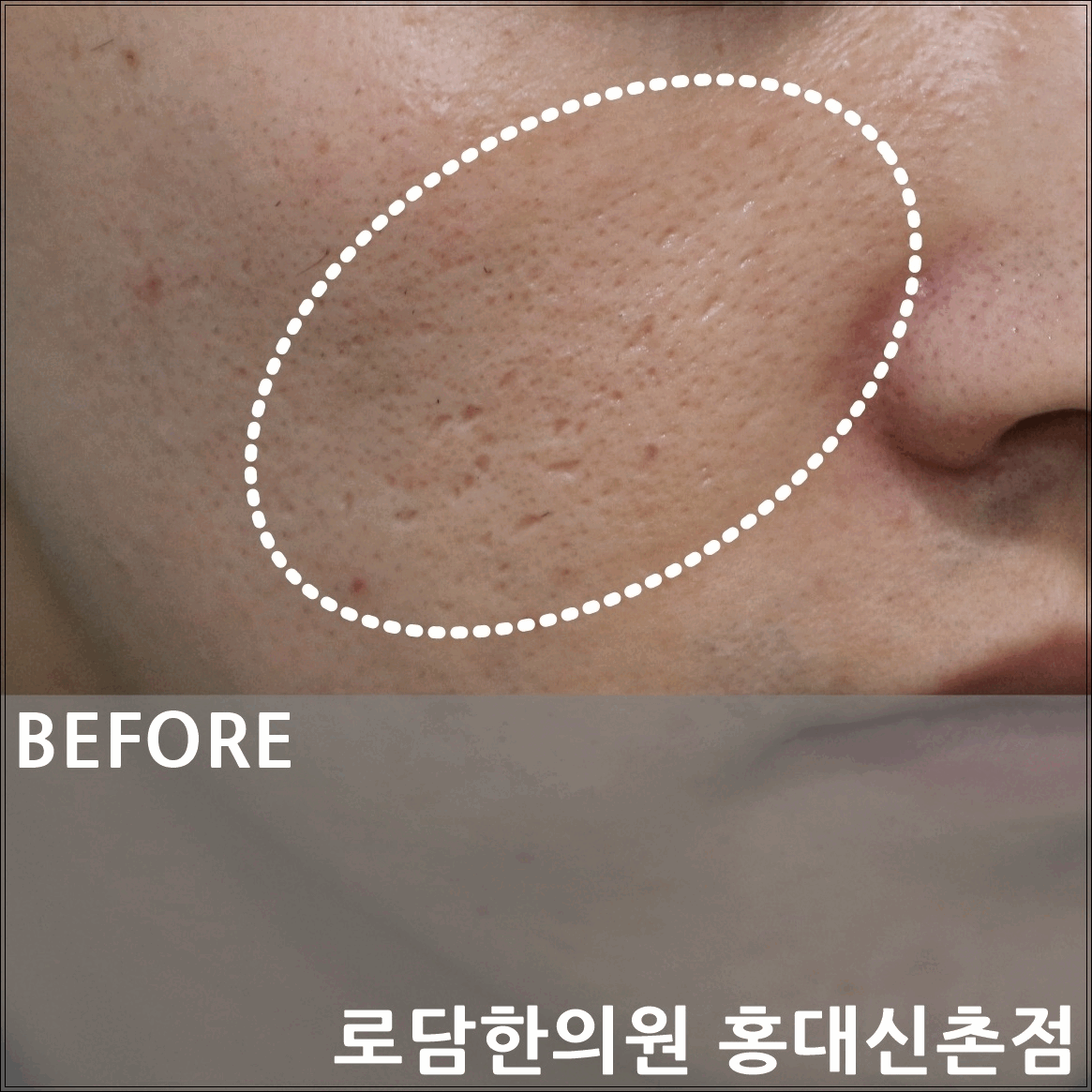  홍대 여드름 흉터 제거 치료 과정 새살침 코라테라피