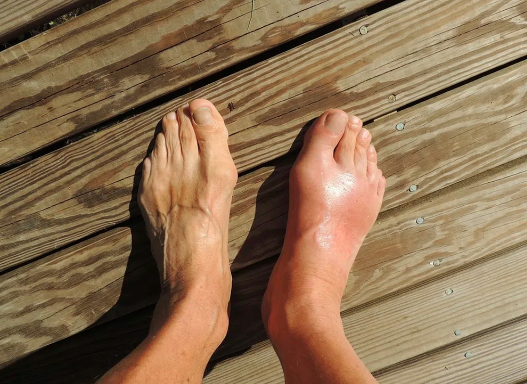 발 뒤꿈치 통증 증후군: 왼쪽 대 오른쪽