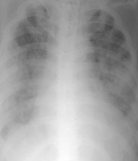 비심인성 폐부종 방사선 사진