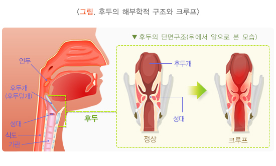  크루프(후두염)
