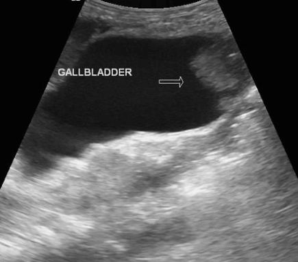 Gall bladder carcinoma (담낭암)