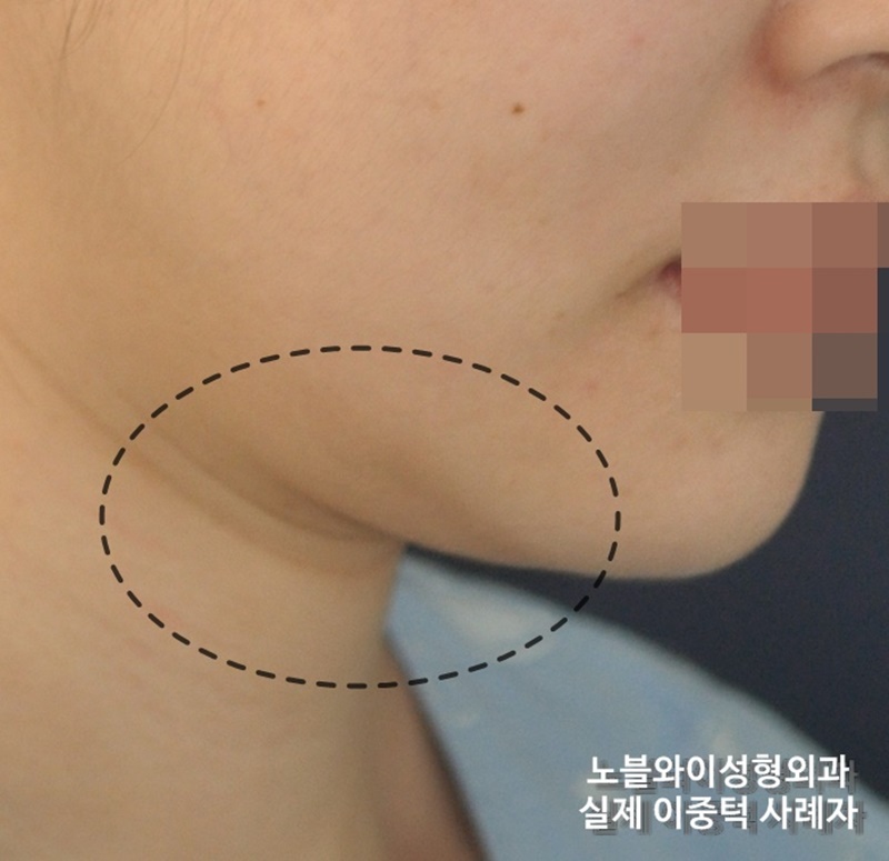  이중턱없애는방법 이런 이유였네
