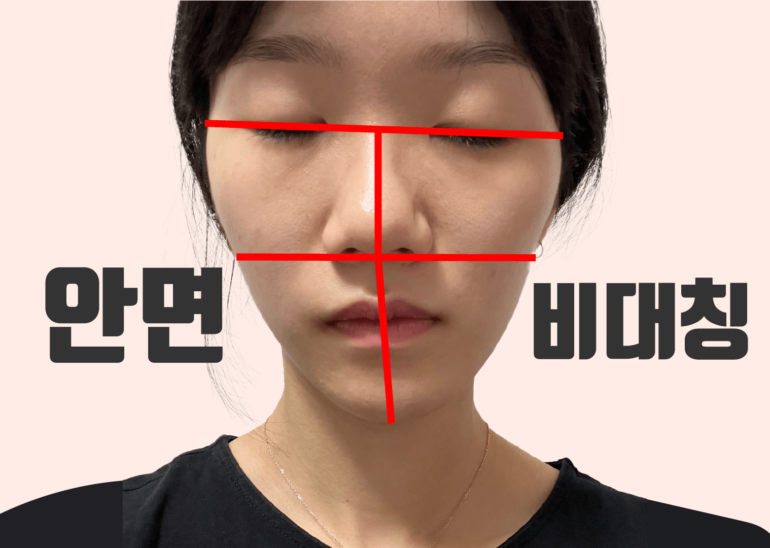 첫달, 악궁확장치료 중 - 저는 얼마나 바뀌게 될까요?