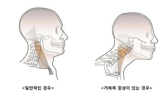 거북목 증후군 사진