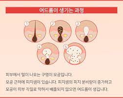 여드름의 원인