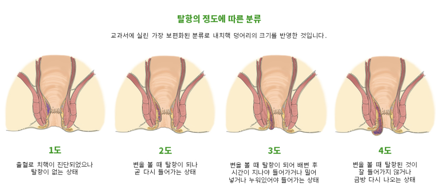 치질 증상