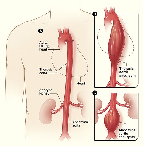 동맥-정맥-질환-동맥류