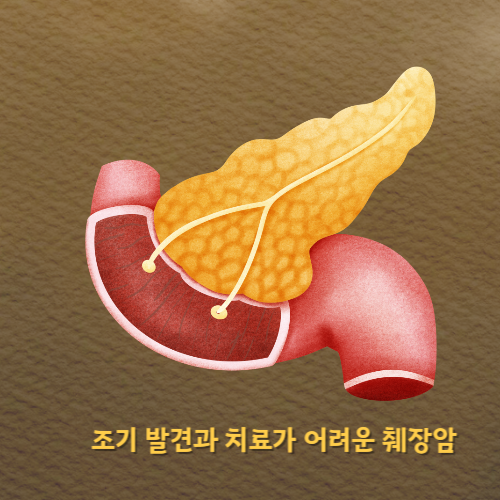 췌장암