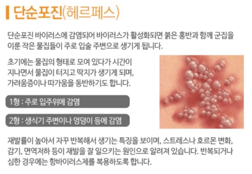  단순 포진 증상 원인 치료방법 / 헤르페스 바이러스란? 성병?