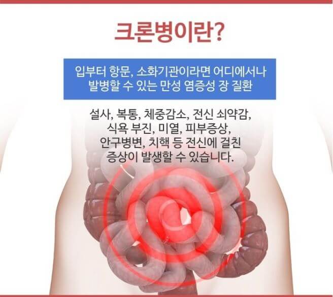 크론병 증상