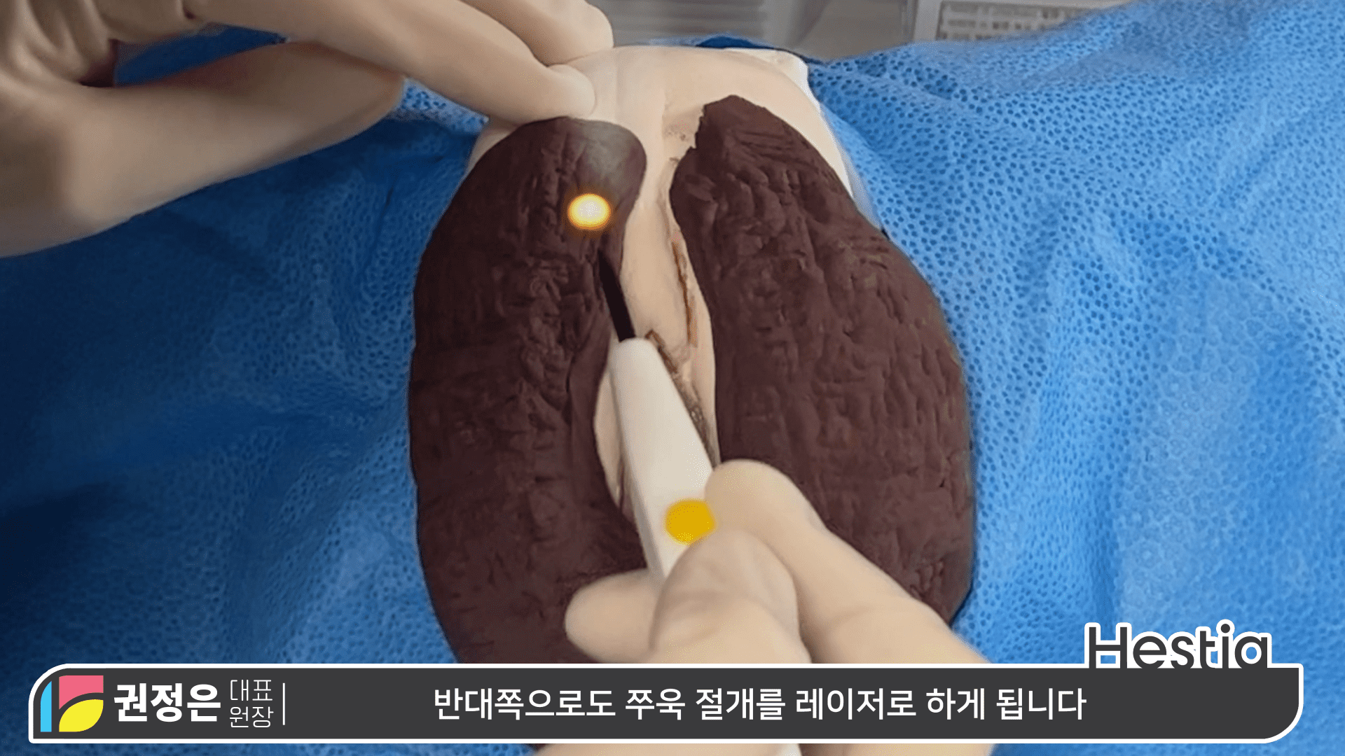 대음순성형수술 시물레이션