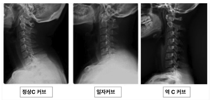 C커브-경추-모양