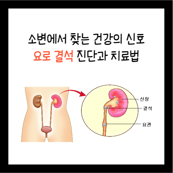  소변에서 찾는 건강 신호: 요로 결석 진단과 치료법, 예방법