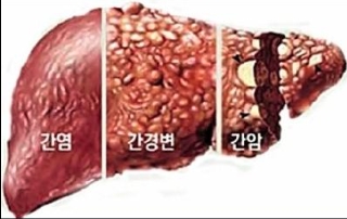 알코올성 간질환 간
