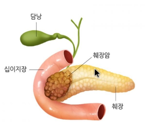  췌장암 초기증상 원인 자가진단 정보 총정리