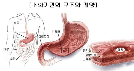 위궤양 증상