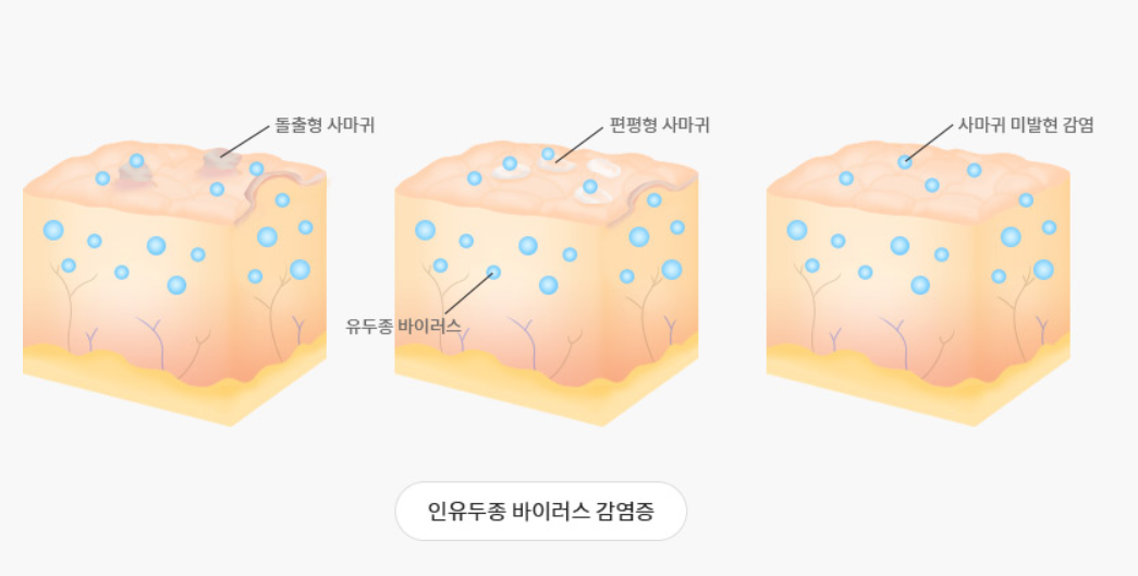  외음부곤지름 증상과 원인은 무엇인가?