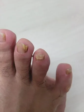 라셀턴 사용법과 가격 비교 발톱앰플 후기 정리해보기_4