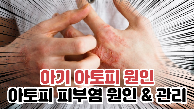피부암