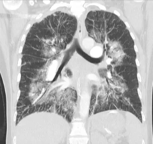 central peribronchovascular distribution, interloblar septum thickening