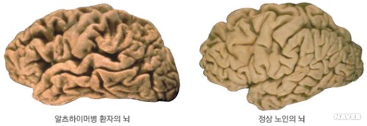  알츠하이머<alzheimer's disease>