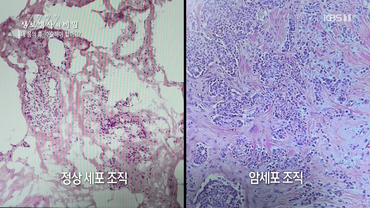 생로병사의 비밀.E870.230532p.H264-F1RST.mp4_20230605_201516.994.jpg