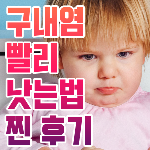 구내염 빨리 낫는법 찐 후기
