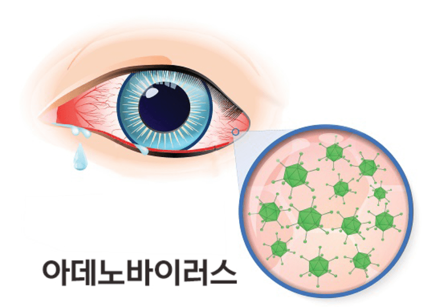  영유아 주의! 눈꼽 감기 아데노 바이러스 증상 원인 예방법