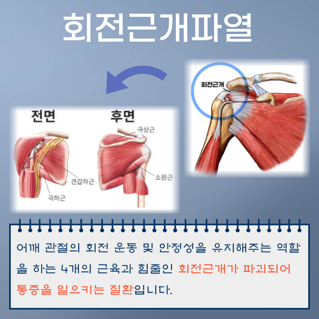 회전근개파열 정의